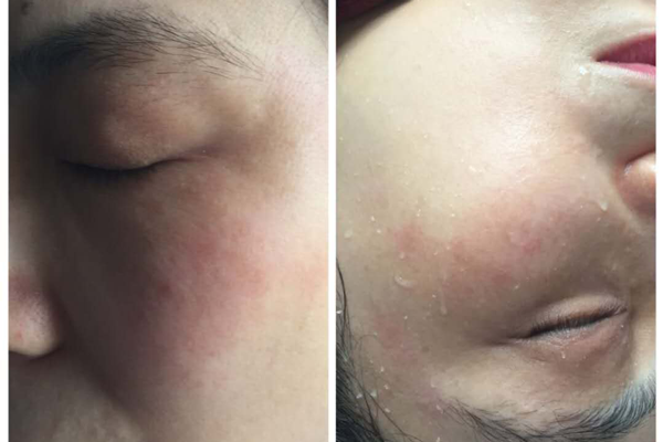 红血丝一次效果展示